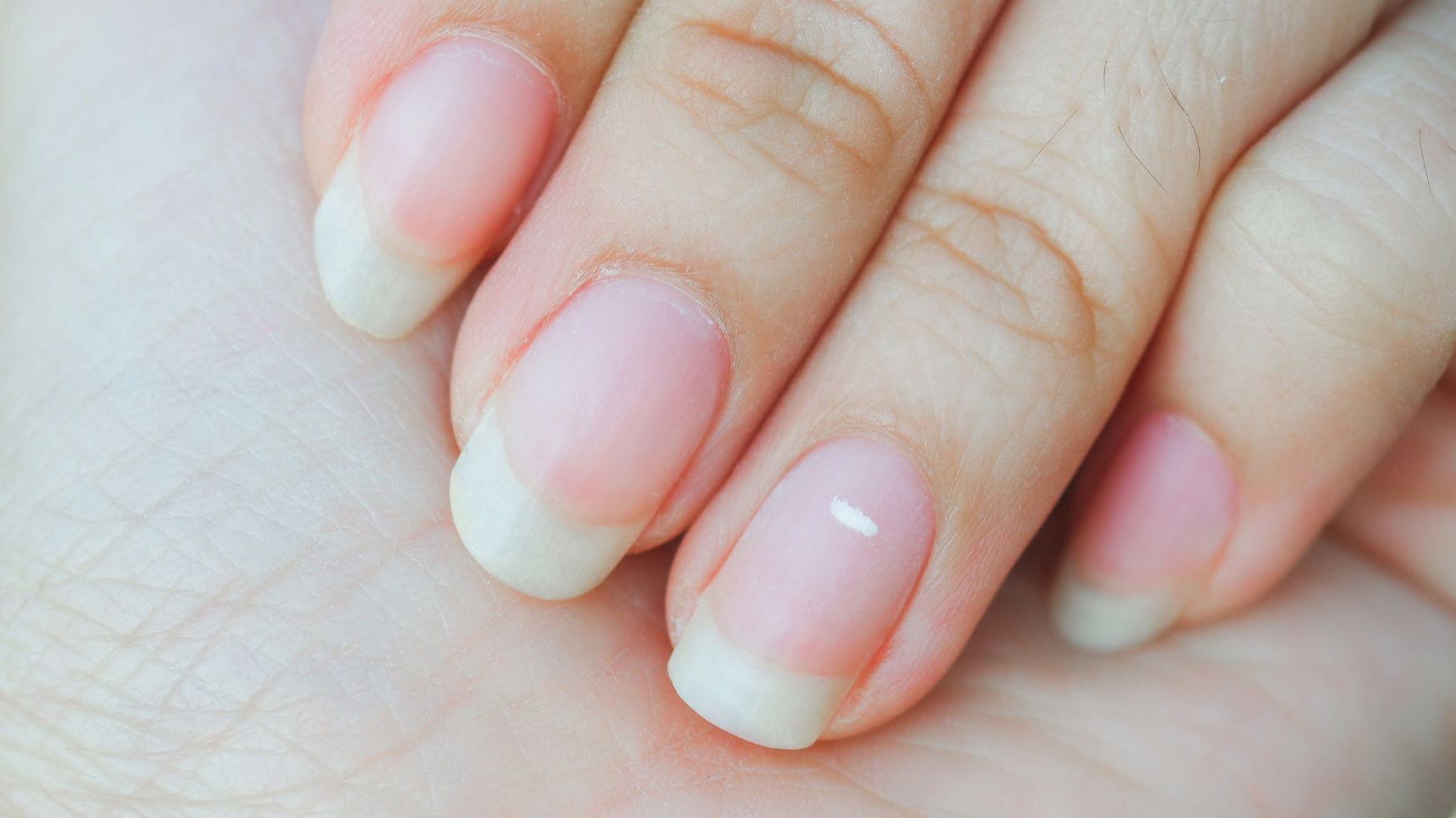 Tech Tips: Understanding Leukonychia